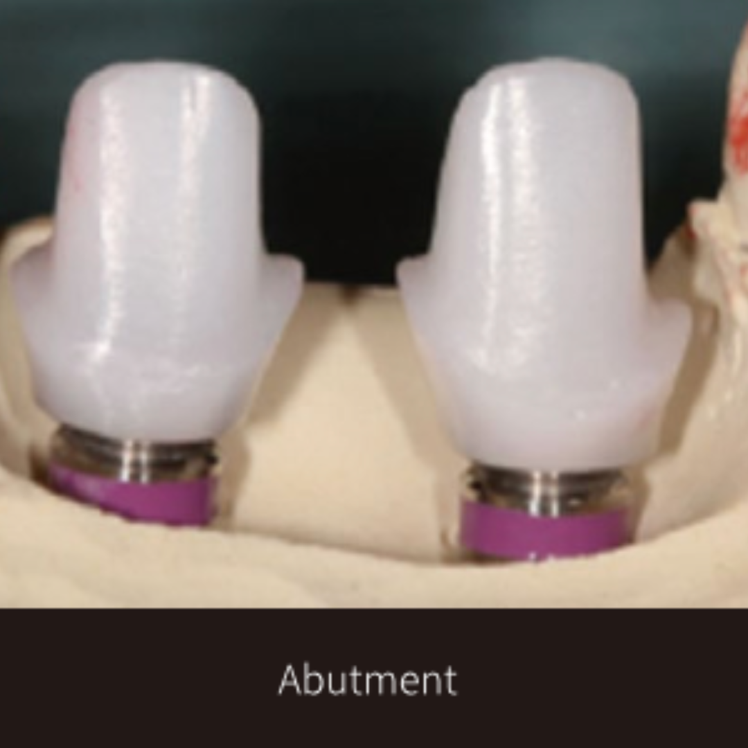 Dentitude Implant